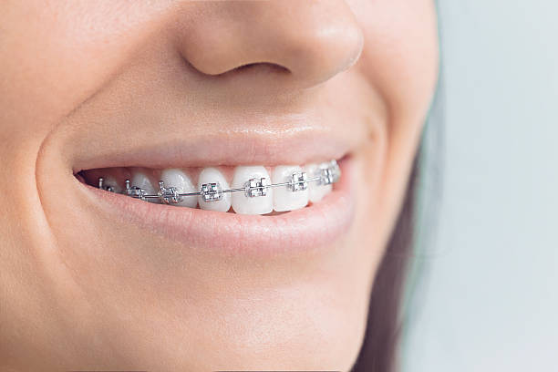 Best Traditional Braces  in Union, OR